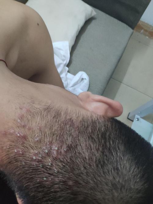 头部毛囊炎能经常洗头发吗