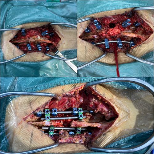 先天性脊柱侧弯畸形  l3椎体半椎体畸形 腰椎侧后 突畸形 手术方案