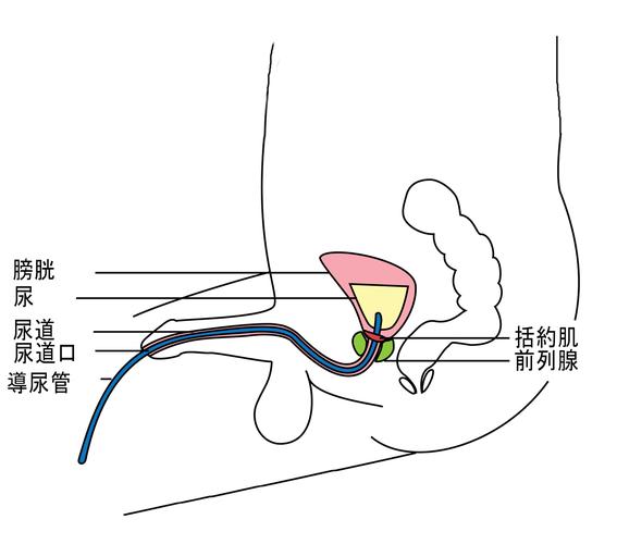 男性间歇性导尿法 (ic for men)