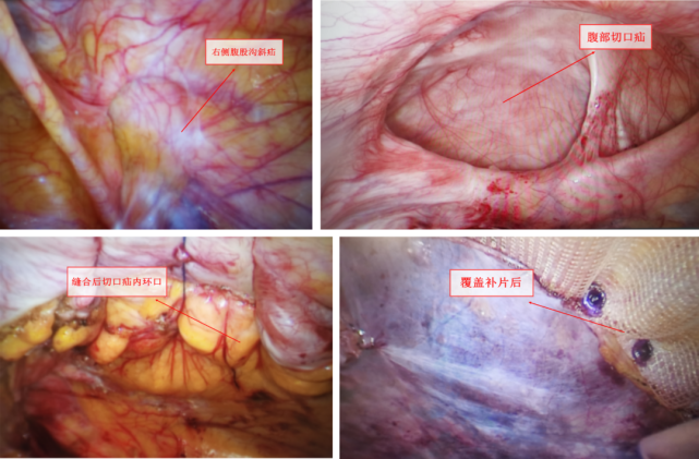 直疝,闭孔疝等腹股沟区域的疝外一科已成功完成了彭山区首例全腹膜外