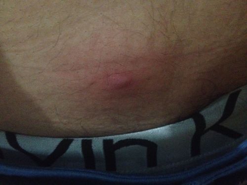 小肚之前长了一个硬疙瘩…这几天突然红肿一按就疼感觉变大了 里面