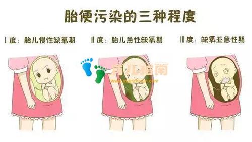 羊水三度污染,导致宝宝被呛胎粪,多科协作上演夺命大战