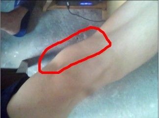 大家看看我的膝盖正常吗还是有点歪的