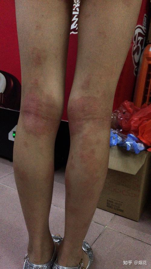 孩子特应性皮炎之路