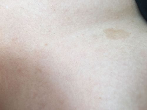 有人知道这是什么吗?胸前的一块颜色跟皮肤不一样