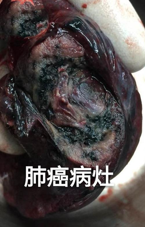 电子烟一样导致肺癌