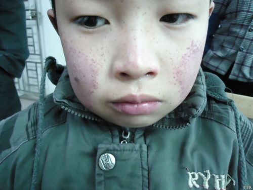 可以下过敏性紫癜的临床诊断不?