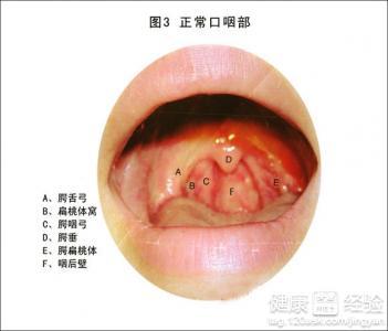 慢性咽炎经常咳嗽怎么办