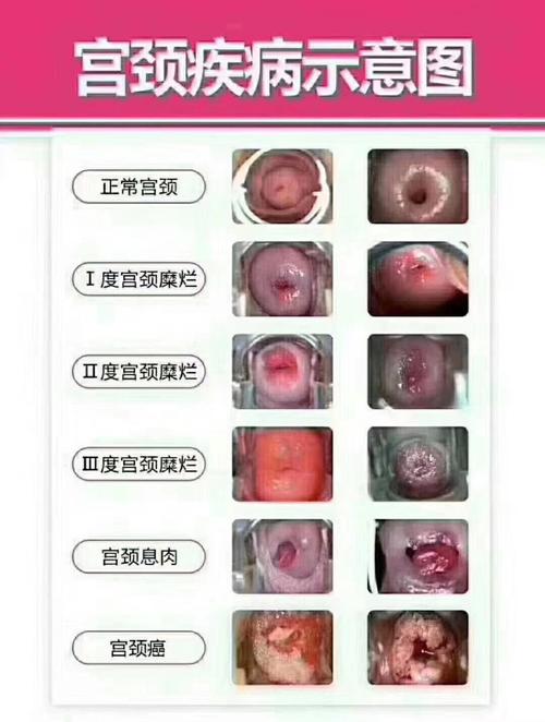 宫颈中度糜烂怎么办_宫颈中度糜烂则么治疗_南宁中度宫颈糜烂该如何