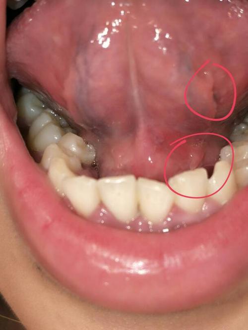 请医生帮我看下是尖锐湿疣吗,舌头下面和底部总共长了