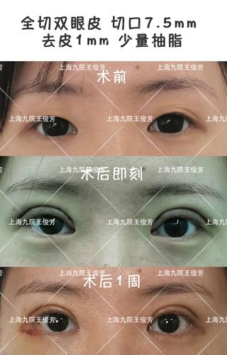 抽脂】案例分享 本来就是有双眼皮了,上眼睑脂肪还是很肥厚怎么办呢?
