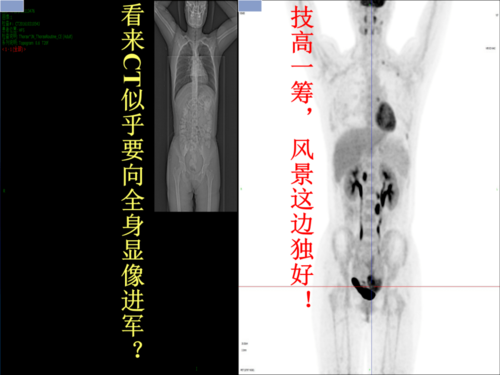 【分享】高建英:pet/ct在女性生殖系统肿瘤中的价值