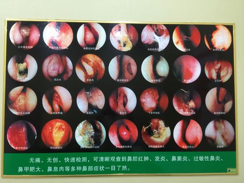 鼻腔护理中心 写美篇 康氏启航 鼻腔护理中心  鼻炎,是指鼻腔黏膜和