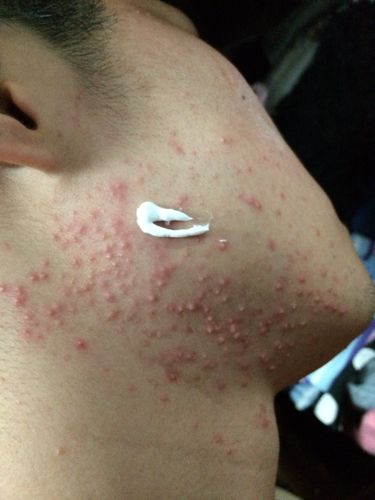 请问这是毛囊炎吗?我就这两天突然冒出来这么多,不懂怎么办!有点痒!