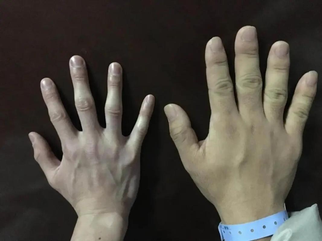 "肢端肥大症"是咋回事