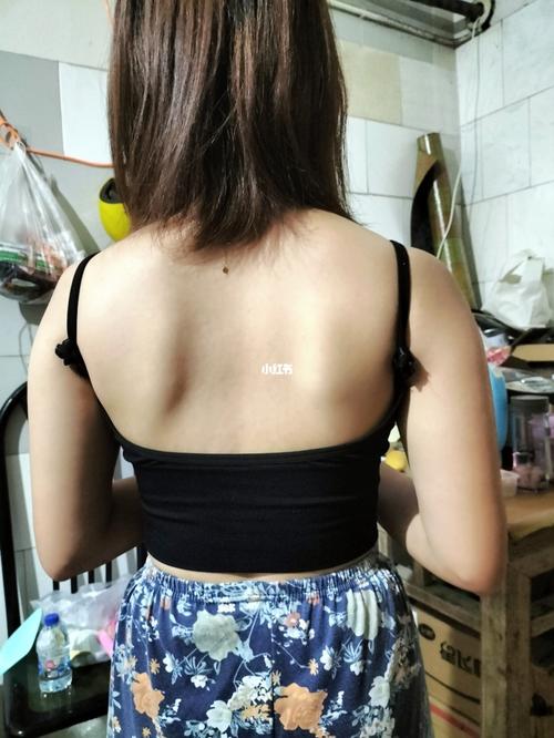 救救孩子吧,肩胛骨突出_运动健身_医疗健康_医疗健康