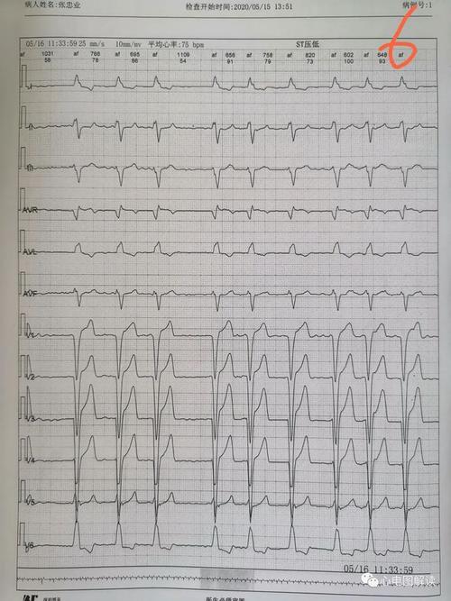 心电图解读完全性左束支传导阻滞合并缺血及鉴别