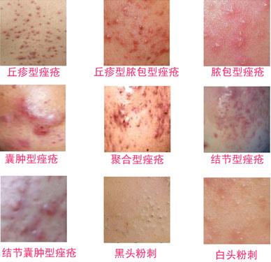 痤疮的常见病因有哪些?