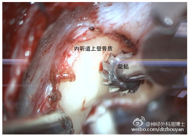 看图说手术-听神经瘤 (转载)
