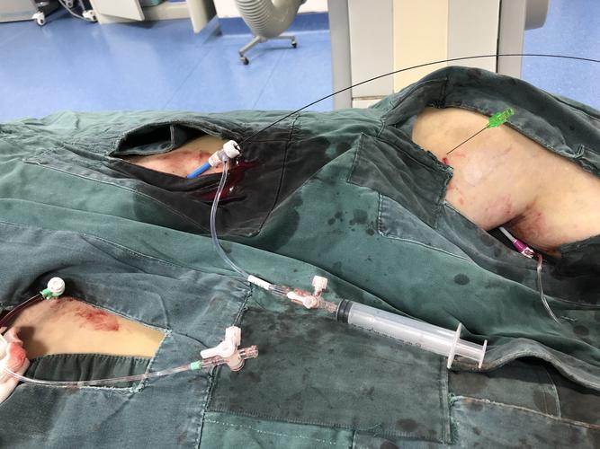 全下肢静脉穿刺,双侧股静脉,左侧腘静脉(术前超声下留置),左侧股浅