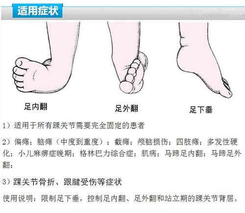 邻居家2岁的宝宝,就因为妈妈买的鞋子不合脚,造成孩子足外翻.