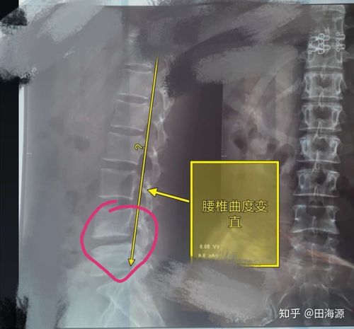 我们看到整个腰椎曲度已经变直了,以前下段腰椎的弧度已经一去不复返