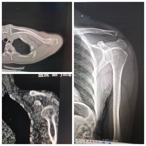 肩锁关节半脱位,ct轴位看不到,多平面重建及dr显示间隙增宽,避免了漏