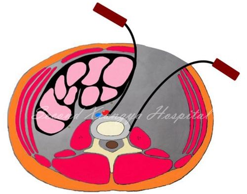 另一拉钩置于椎体侧前,交感神经链前方,将其稍向后牵开;血管拉开示意
