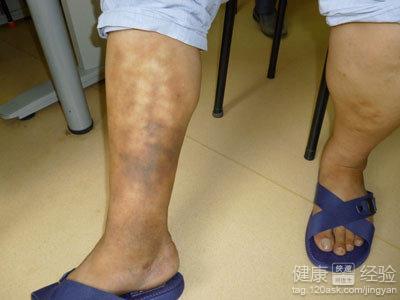 得了下肢静脉血栓形成怎么办