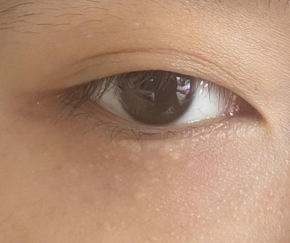 眼下长得是汗管瘤丘粟疹还是脂肪粒
