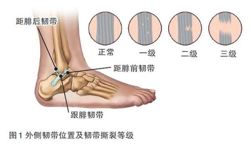 踝关节扭伤的诊治及预防