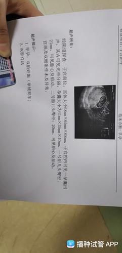 宝宝的第二张照片,二超检测是单绒双羊