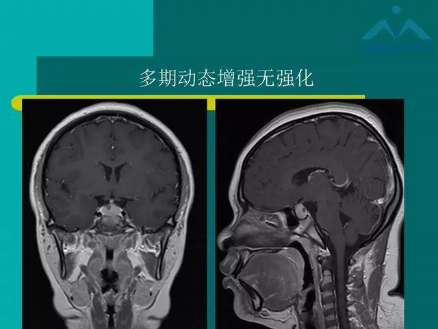 儿童rathke裂囊肿的影像与临床