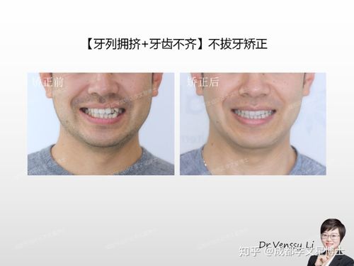 6,双侧磨牙中性关系,所有拥挤基本上集中在左侧; 7,牙弓基本正常,1期