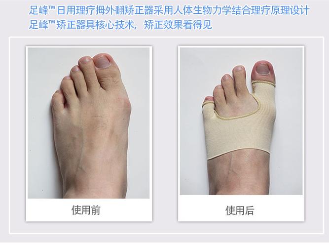 尖头皮鞋,前足被包裹挤压,会逐渐形成拇趾外翻,小指则内翻