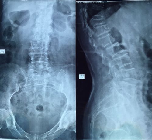 患者的脊椎正侧位x片