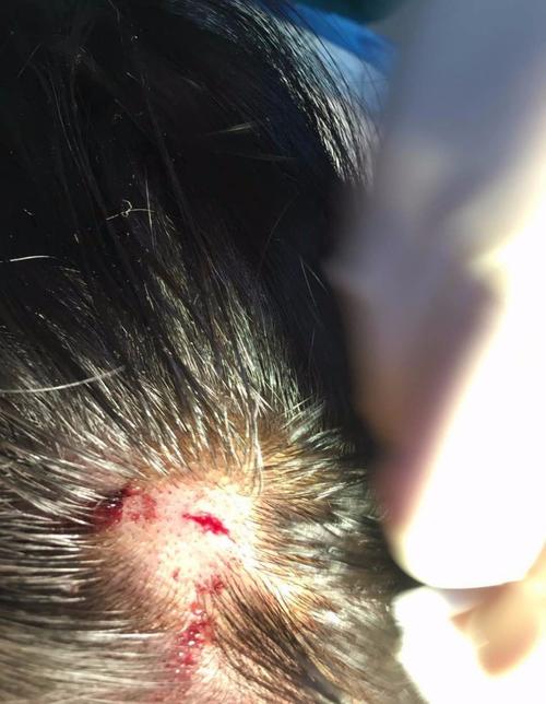 黄灿灿拍戏时被砸受伤严重吗现在怎么样黄灿灿受伤头部流血不止图