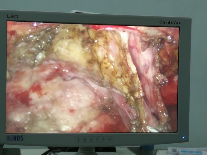 乳腺囊肿的腔镜微创手术