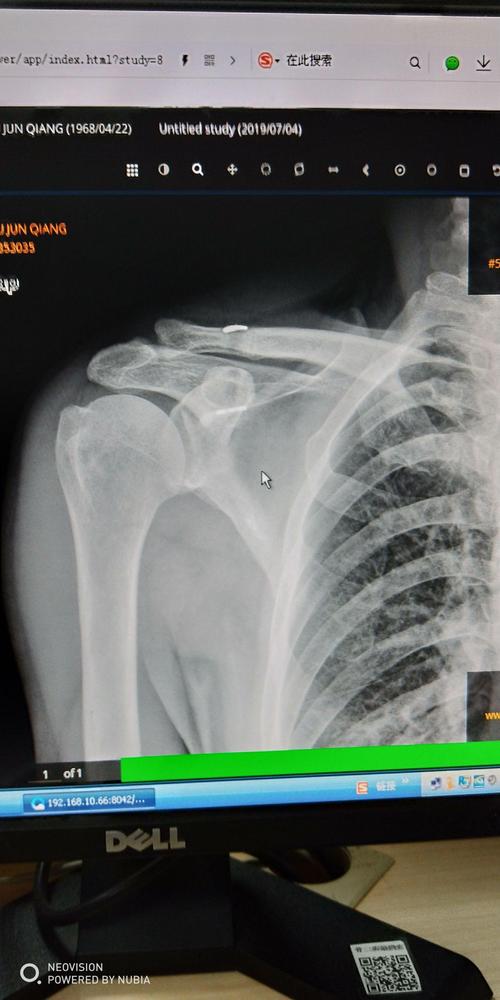 右肩锁关节脱位纽扣钢板固定