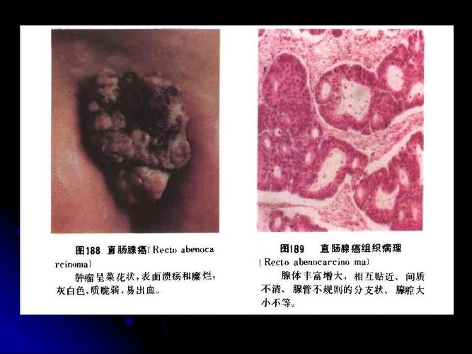 肛门直肠恶性肿瘤ppt