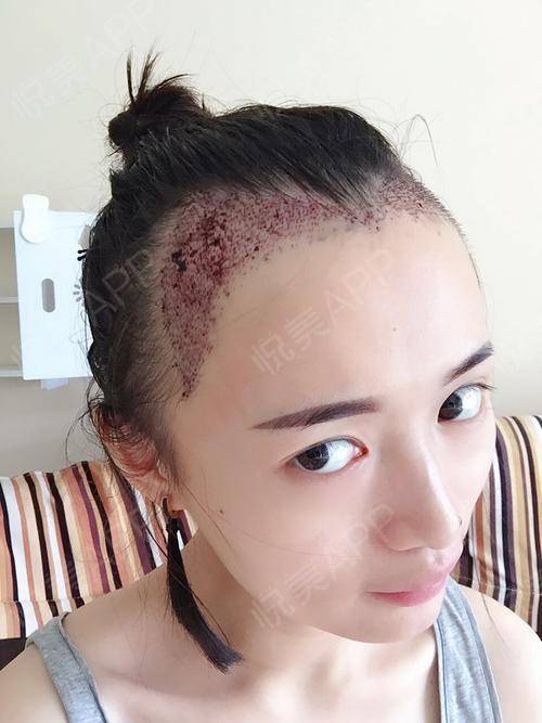 种植发际线手术分享,早就受不了我这大脑门了,终于鼓.