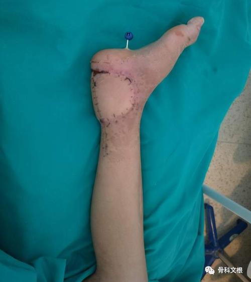 9岁孩童右脚皮肤挫伤感染坏死,上海六院文根显微皮瓣成功保肢