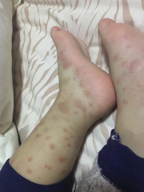 宝宝就只有手上和腿部有这种疹子,到底是什么啊?急急急