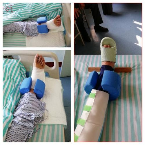 股骨颈骨折(保守治疗)牵引!长时间以同一姿势卧位足跟更是受压严重!