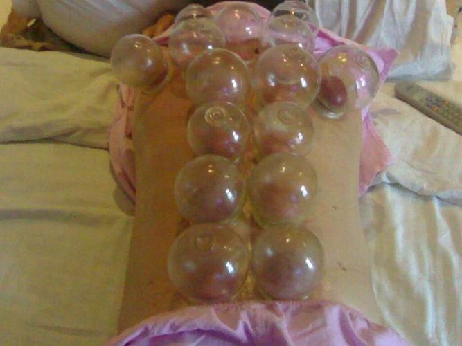 刮痧,拔火罐有疗效,简便易行