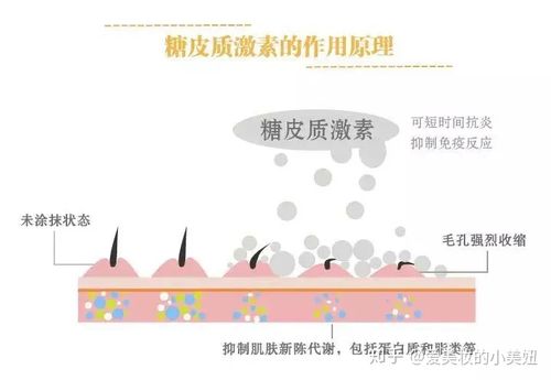 激素脸又被称为糖皮质激素依赖性皮炎,是面部长期使用含糖皮质激素