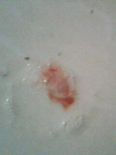 痰里带血,鼻腔出血.求解.