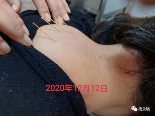 筋膜针灸i富贵包不富贵针灸半月减大半