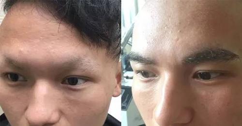 图为21岁李先生先天眉毛稀缺, 眉毛种植前后对比照片