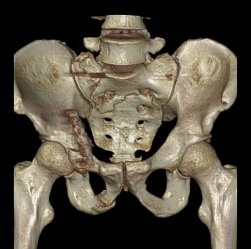 骶骨骨折,骨折端移位已明显复位,固定牢固,手术效果好!